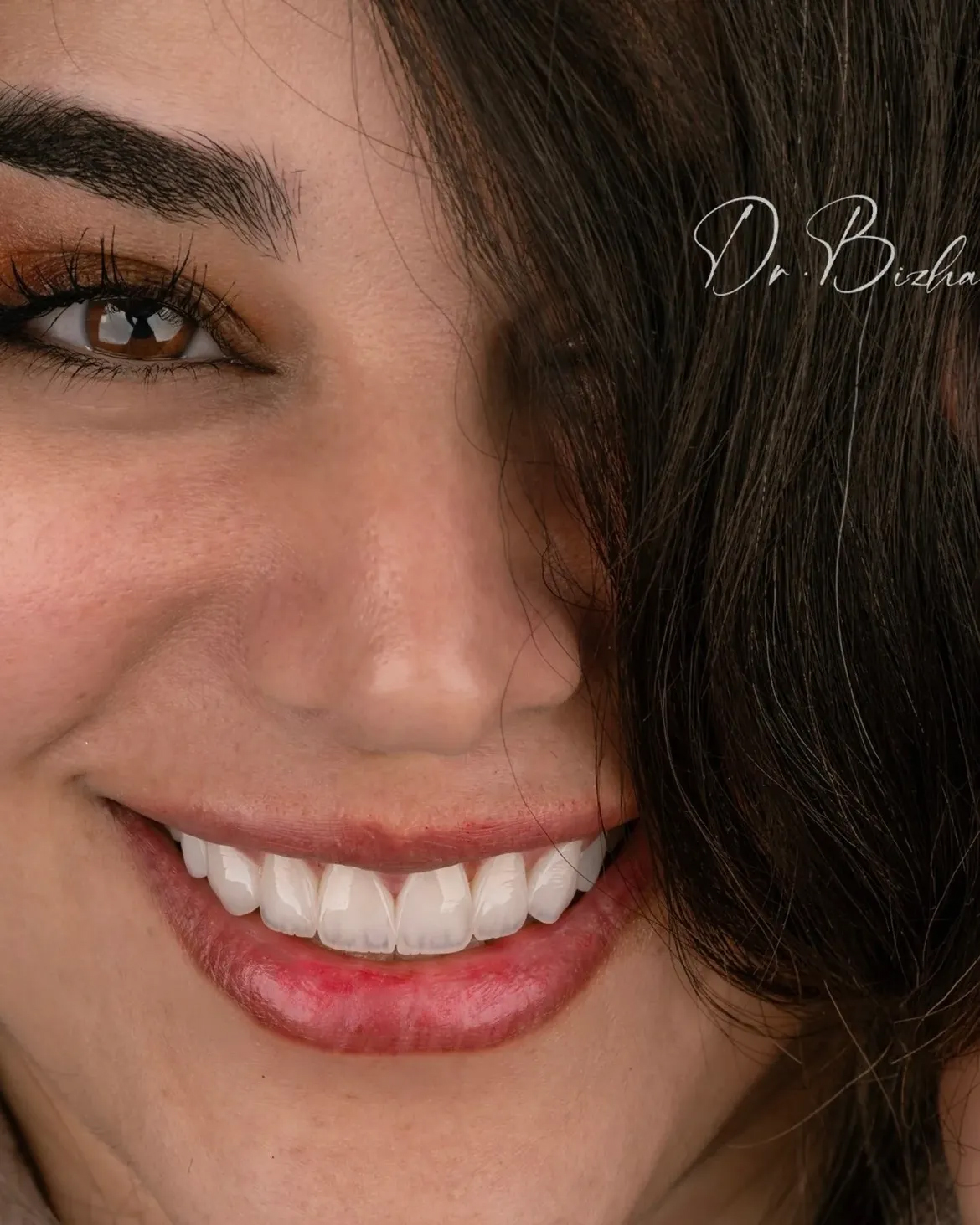 اصلاح قوس لبخند