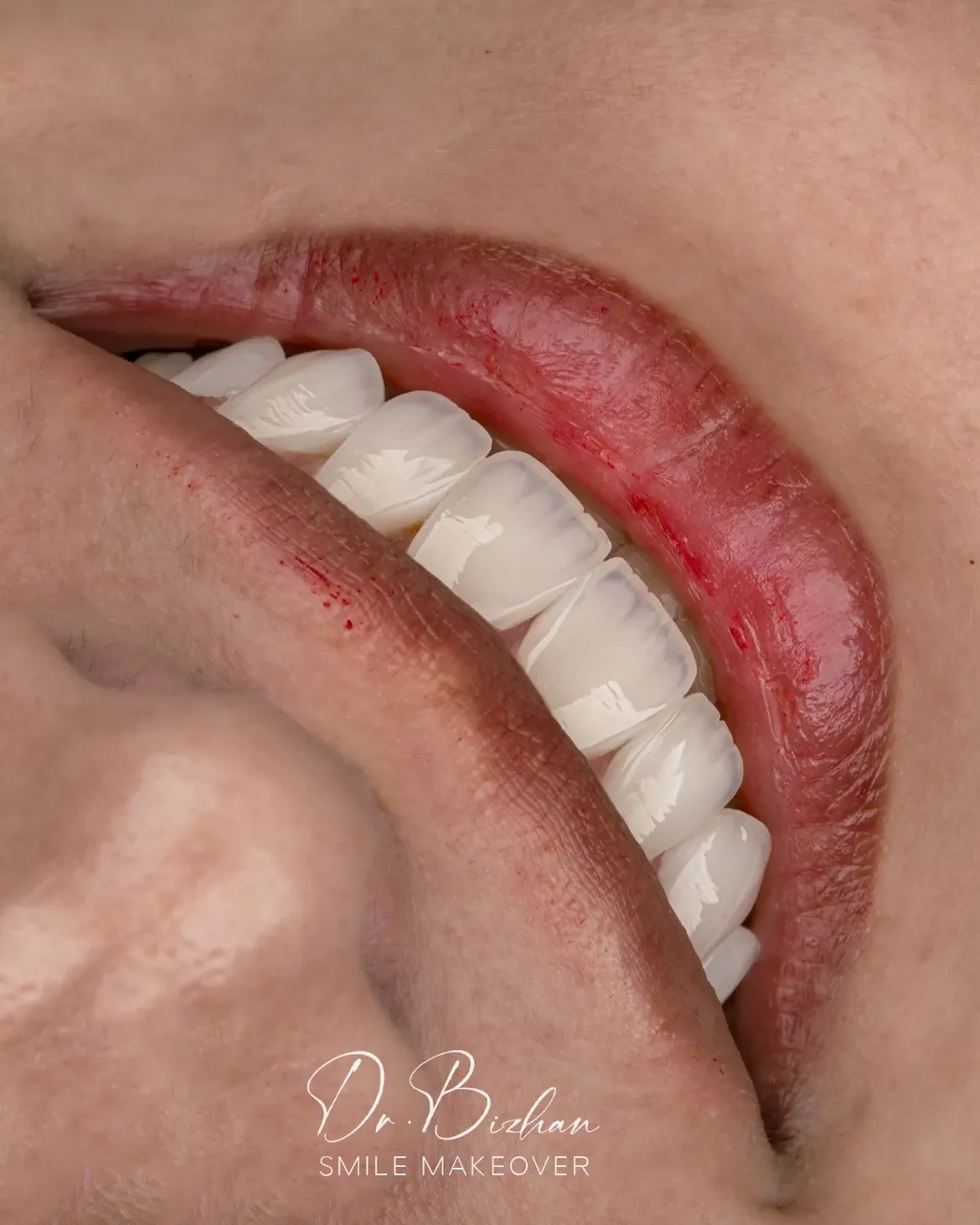 اصلاح قوس لبخند